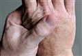 Ask the Doc: 'What exactly is gout and how do I know if I have it?' 