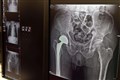 Hip fracture recovery ‘varies between hospitals’ – study