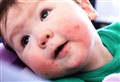 Ask the Doc: 'I'm worried about my child's rash – what should I do?'