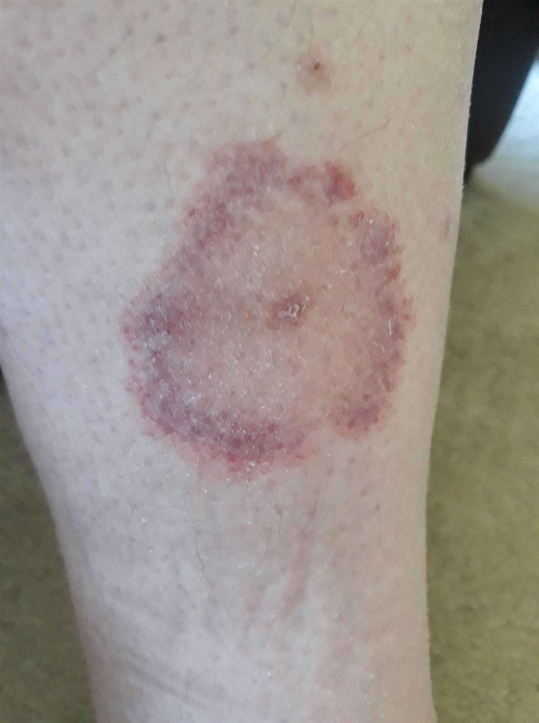 Once bitten: Mr Lobban's leg after the tick bite