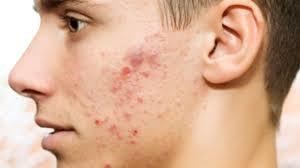 Acne is a common problem and there are treatments available.