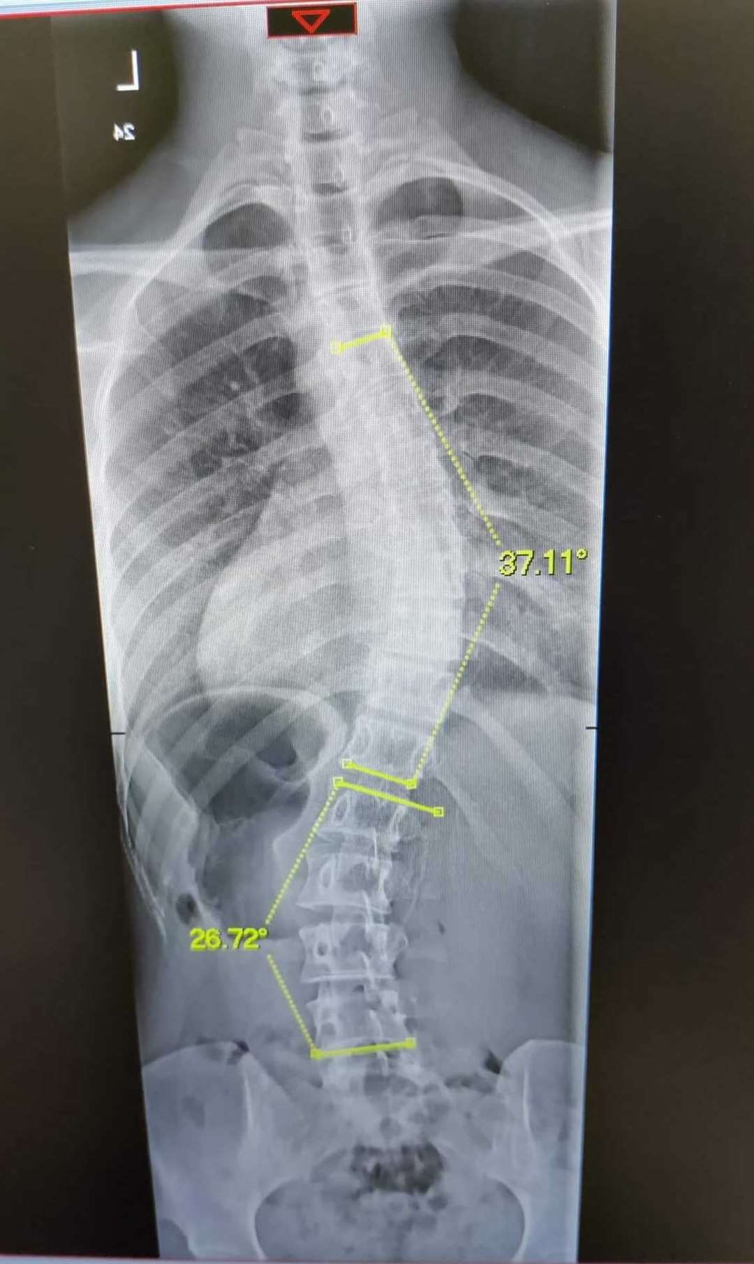 The x-ray of Jenna's spinal scoliosis.