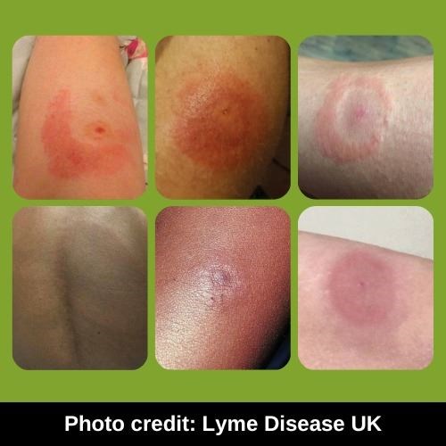 Lyme Disease - Rash effects