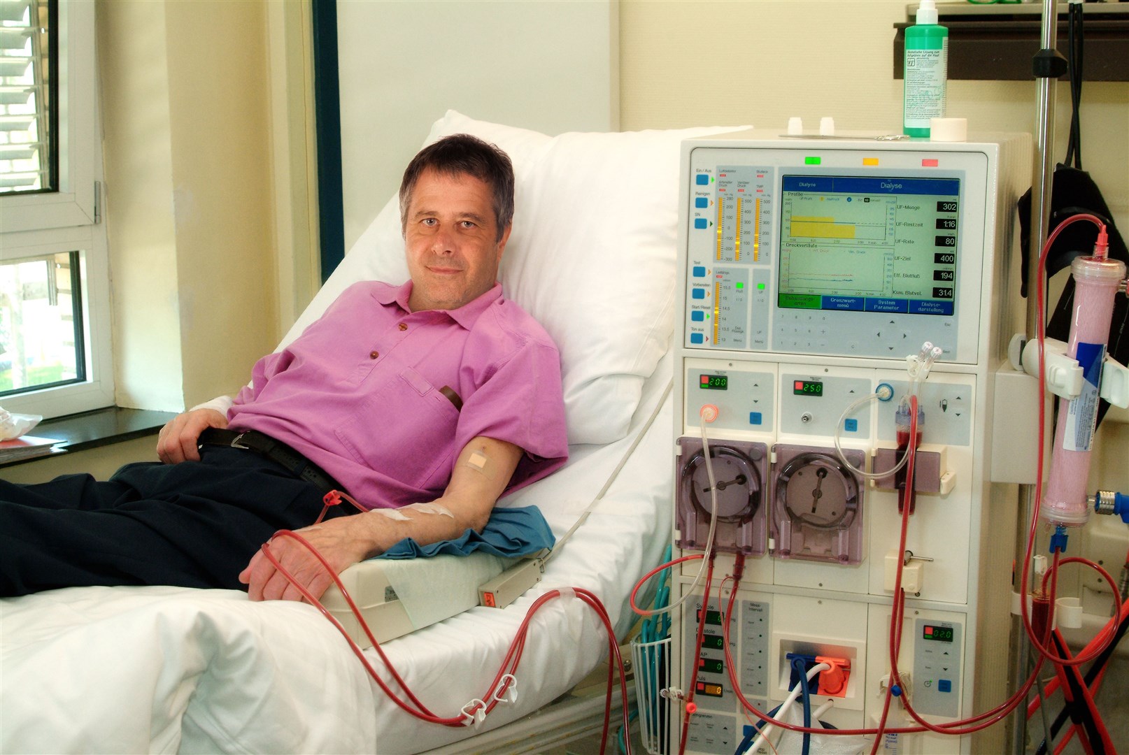 A patient on kidnesy dialysis.